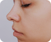 تزریق فیلر بینی جهت اصلاح فرم - بعد از درمان