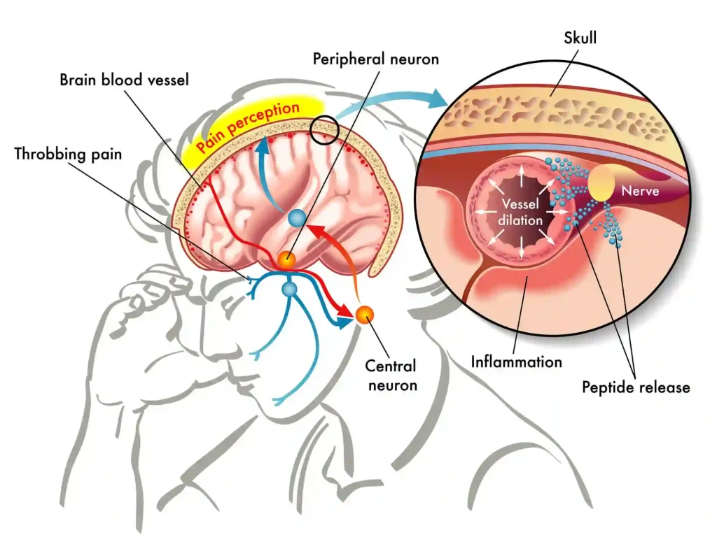 نمودار تشخیص سردردهای خطرناک