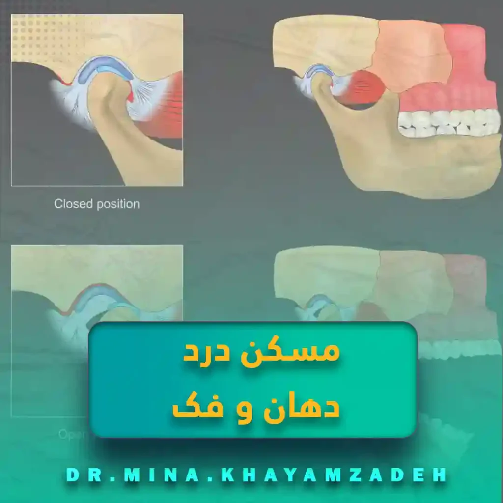 مسکن درد دهان و فک | راهنمای تخصصی درمان دردهای دهان، فک و صورت