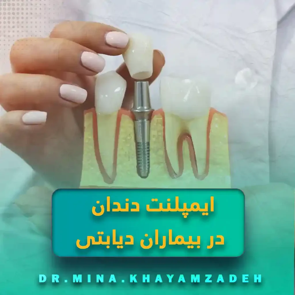 🦷 ایمپلنت دندان در بیماران دیابتی: چالش‌ها، راهکارها و میزان موفقیت